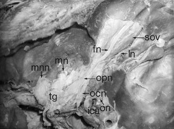 Fig. 3 The dura lining the middle cranial fossa and forming the lateral wall of the cavernous sinus and Meckel's cave are removed.