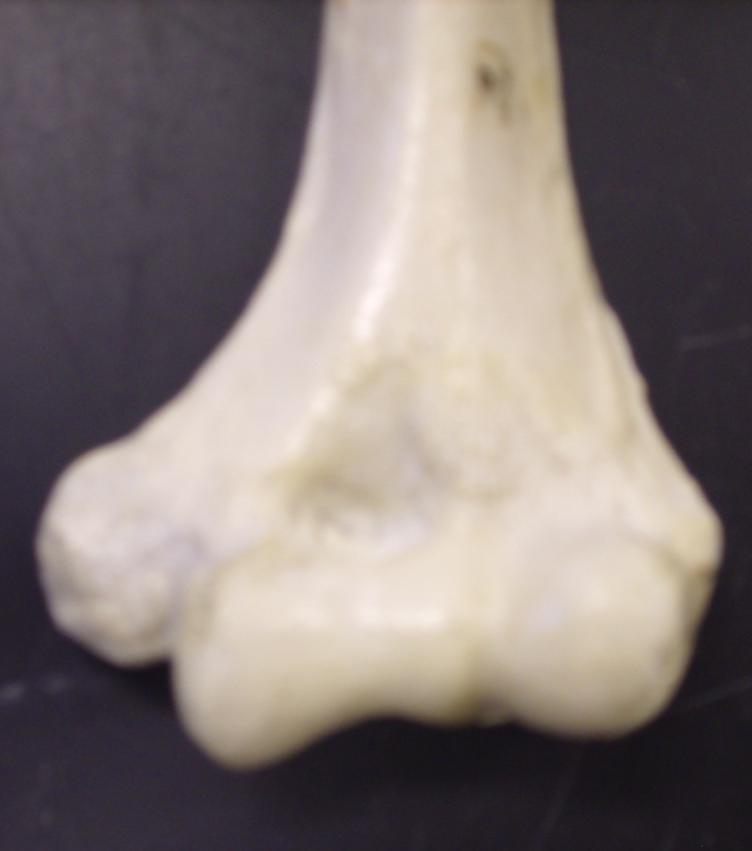 (right anterior view) Trochlea Medial Epicondyle