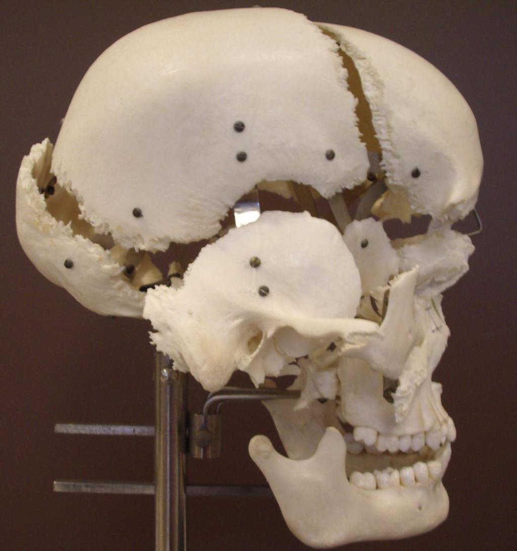 Beauchene Skull Lateral View Parietal Frontal