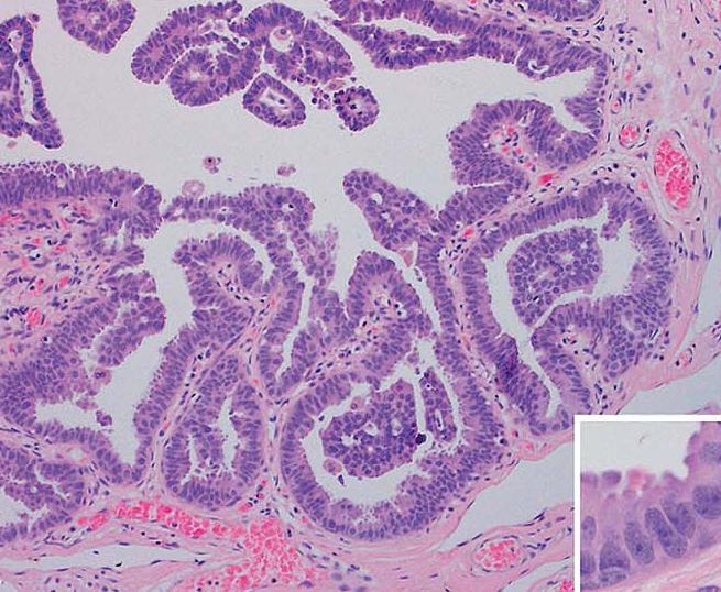 Columnar Cell Hyperplasia