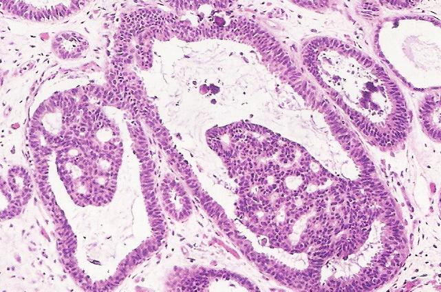 to the presence of cribriform spaces or micropapillae, are now proposed by several Pathologists