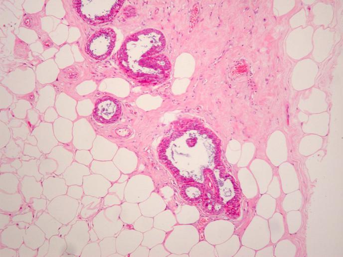 Columnar Cell Lesions (CCLs) CCLs are characterized by the