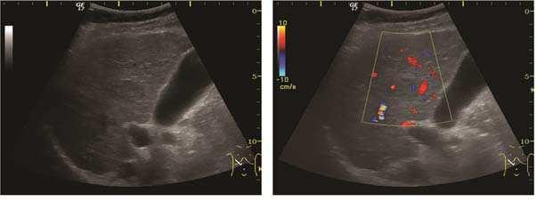 Ultrasound Imaging of Liver Tumors Current Clinical Applications 89 B-mode ultrasonography is unable to distinguish between regenerative nodules and "borderline" lesions such as dysplastic nodules