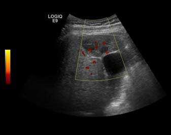 On CEUS examination, early HCC has an iso- or hypervascular appearance during the arterial phase followed by wash out during portal venous and late phase.