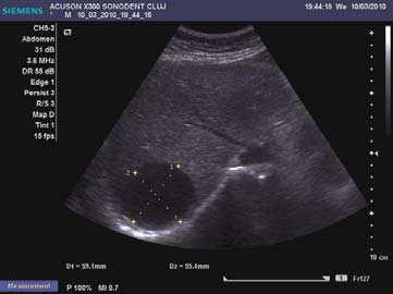 Ultrasound Imaging of Liver Tumors Current Clinical Applications 81 2.2.1 Liver cysts They can be single or multiple, with variable size, generally less than 20 mm (congenital).