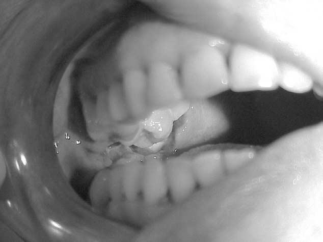 1202 LIMITED PAINFUL MOUTH OPENING FIGURE 1. Intraoral view of the lesion. ous extraction or the carious and mobile upper right third molar.
