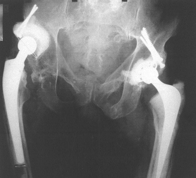 EARLY FAILURE OF TOTAL HIP REPLACEMENTS IMPLANTED AT DISTANT HOSPITALS TO REDUCE WAITING LISTS CIAMPOLINI Figure 2 78-year-old man, osteoarthritis
