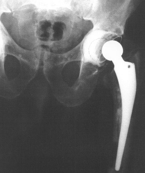CIAMPOLINI EARLY FAILURE OF TOTAL HIP REPLACEMENTS IMPLANTED AT DISTANT HOSPITALS TO REDUCE WAITING LISTS Discussion Figure 4 66-year-old man. Malpositioning of the cup with lateralisation.
