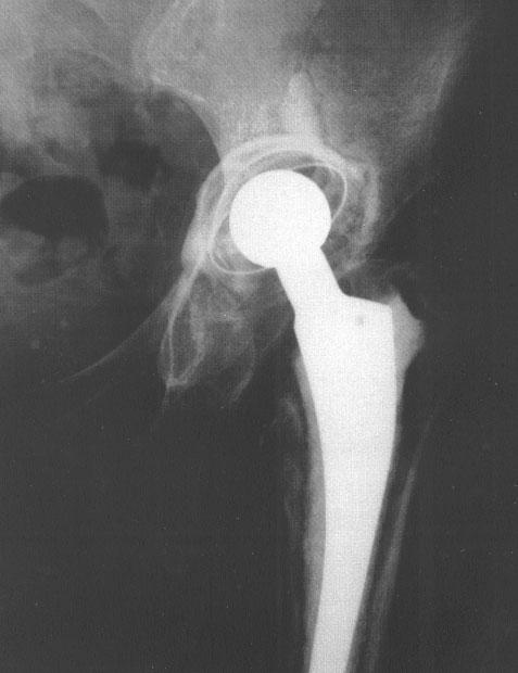 Primary total hip replacement surgery carried out at the local orthopaedic centre during the same time period has a published revision rate for septic and aseptic loosening of 4.