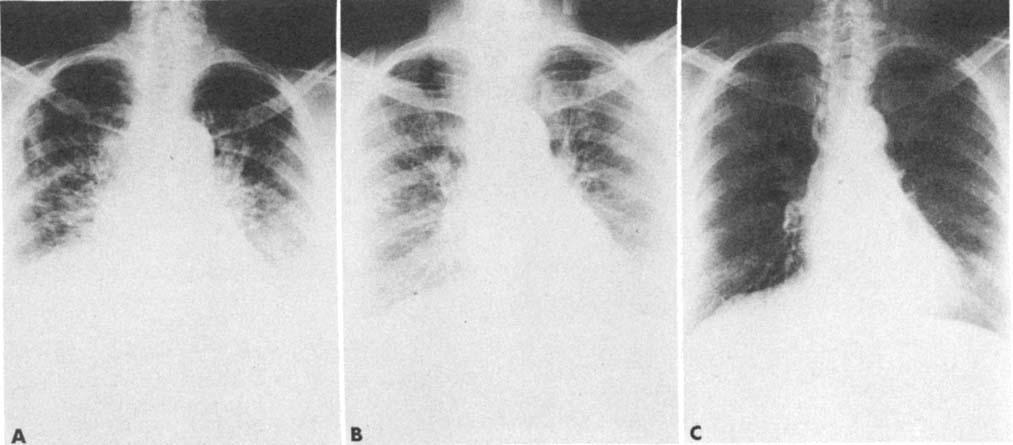 Chemotherapy for Carcinoma of the Lung FIG. 1. (Patient I.} (A} Admission chest roentgenogram demonstrates bilateral lower lobe infiltrates and pleural effusions.