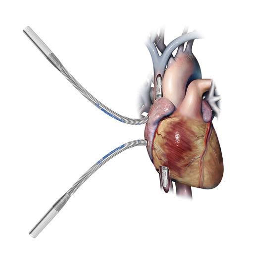 VENOUS CANNULAE DLP Single Stage Venous Cannulae The DLP single stage tip design enables venous flow to enter through the tip hole and elongated side ports to efficiently drain the heart.