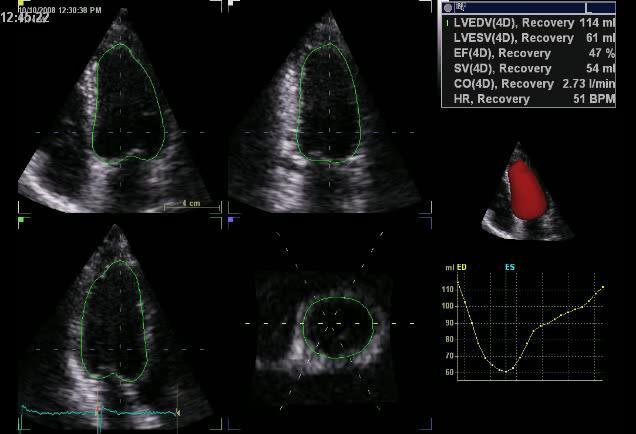 Evaluation of LV volumes and LVEF Changes in ejection fraction and