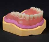 2. Fabrication of radiographic templates Radiographic templates for the edentulous jaw 2.3.3 Remove excess material from the stone model. 2.3.4 Use a duplicating form to duplicate the total denture.