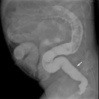 Small bowel dilatation was noted in 14 of 14 patients with TCA (100%) while in one of 53 patients with non-tca HD (1.9%).