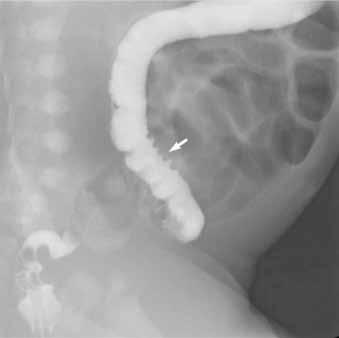 The radiographic transition zone of the 14 patients with TCA was noted at the region from the distal descending colon to the proximal ascending colon in one (7.