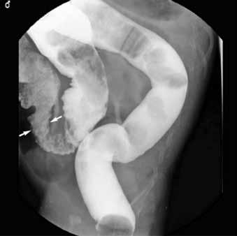For the 53 patients with non-tca HD, the radiographic transition zone was noted at the region from the anus to the proximal sigmoid colon in 43 (81.