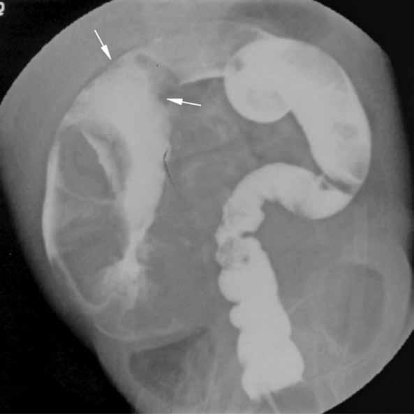 Figure 2 Figure 2. A 2-month-old girl with total colonic aganglionosis (case 9) had a radiographic pseudotransition zone at the transverse colon (arrows). in patients with TCA.
