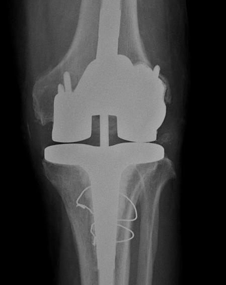 The patient suffered from an infection and osteolysis in the area surrounding a primary joint replacement, causing severe bone loss resulting in a mal-alignment of the tibia-femoral joint which