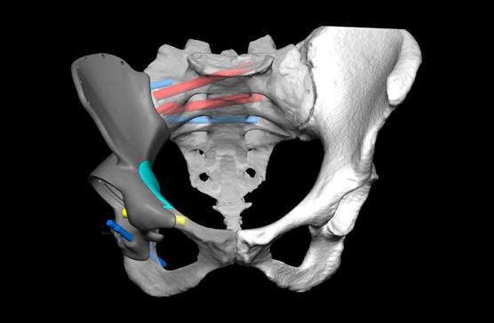 (Image A) MRI review shows that the tumour essentially involved the ilium from the sacroiliac (SI) joint to the acetabulum.