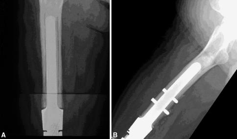 Cemented Distal Femoral Endoprosthesis Advantages Immediate weight bearing Predictable immediate stability in a setting of chemotherapy, poor bone stock Ability to use in irradiated bone May be used