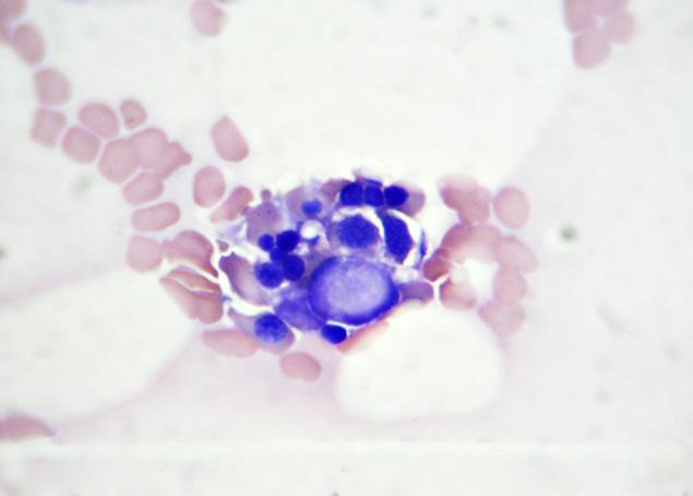 Autoimmune-Associated Hemophagocytic Syndrome/Macrophage Activation Syndrome 91 Fig. 4. Bone marrow aspirate smears.