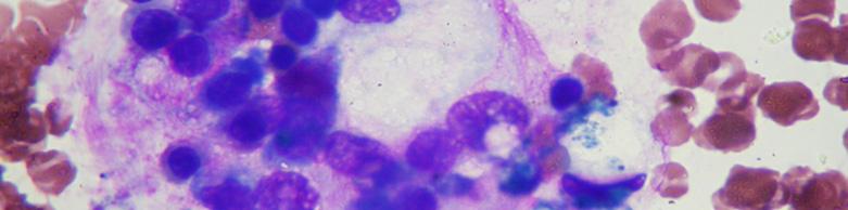 hemophagocytes, with some of these forming cell conglomerates (Fig. 5). Fig. 5. Wright s stain of bone marrow aspirate smears.