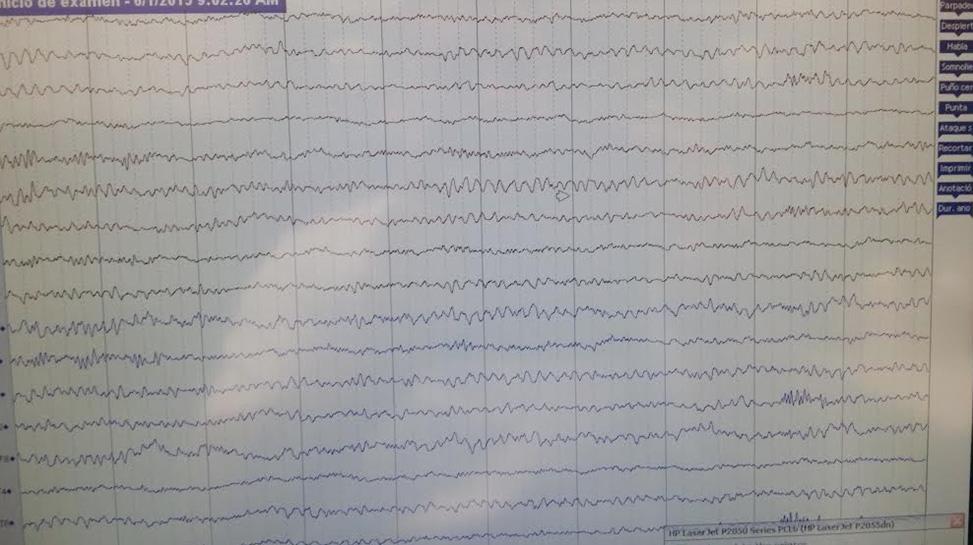 180 CASE 12: DRUGS AND EEG. COCAINE. Regular user of cocaine. 25 years of consumption.