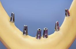 4. MDL Analogs - Analogs are placed into the MDL Abutments in