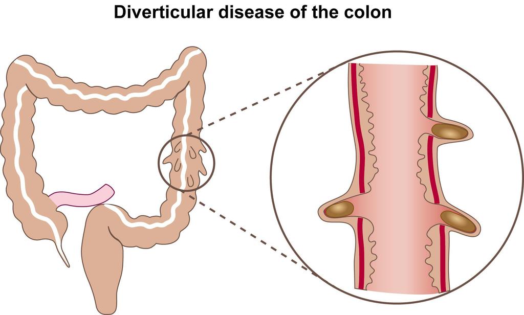 body. The plural of diverticulum is diverticula (used when there are more than one pouch).