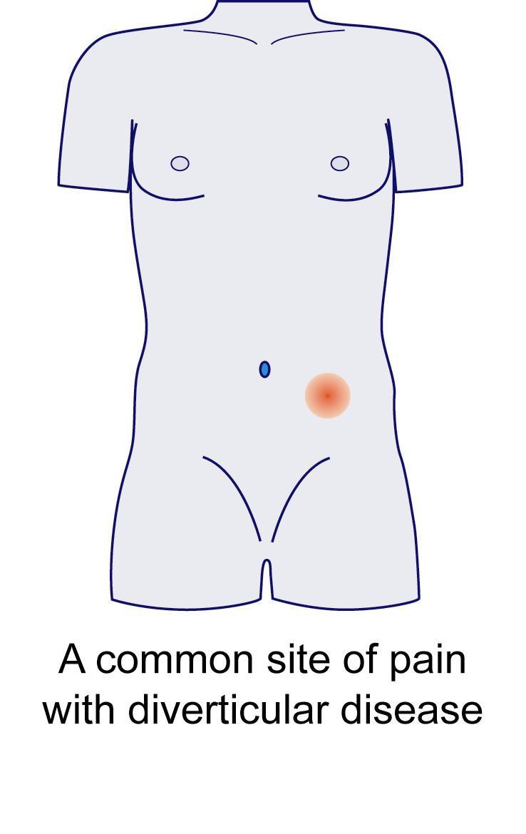 colicky discomfort, especially on the left side of the abdomen distension of the abdomen Occasionally, there may be: pain, which arises because the diverticula become inflamed (diverticulitis) blood