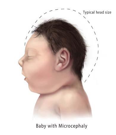 What is microcephaly? Clinical finding of a small head when compared to infants of same sex and age.