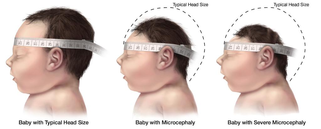 Microcephaly surveillance and monitoring Difficult birth defect to monitor because of inconsistent definition and use of terminology.
