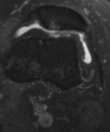 MRI to Assess Articular Cartilage Patellofemoral lesions Arthroscopy debridement/chondroplasty