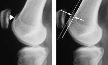 Lateral Tilt Angle Angle should open laterally Parallel or medial increases chance subluxation Dysplasia