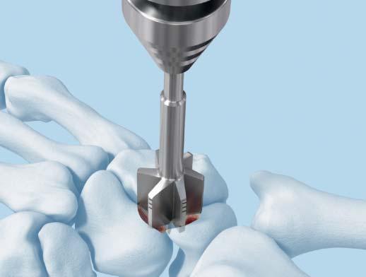 Mount the positioning aid for 2.4 mm VA-LCP intercarpal fusion plate on the combination drill guide (click-on mechanism).