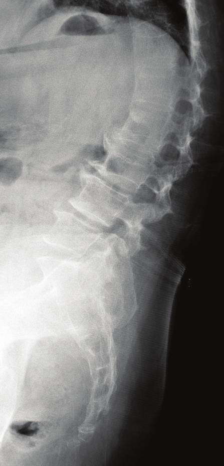 A lateral lumbar radiograph (b) and an axial computed tomography image (c) showed severe osteophytes and end plate sclerosis of the