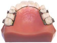 The MemRx D - Distalizing Molars he MemRx D is designed to increase arch length by moving posterior teeth distally.