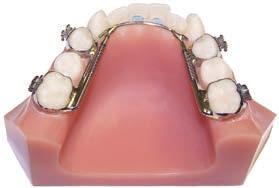 Anchorage is achieved by using bands on the 6-year molars and first bicuspids. Parallel path of insertion between molars and bicuspids must exist for the appliance to fit properly.