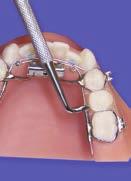 Proper AP is achieved by distalizing the molars via the NiTi open coil springs which are activated by the Inman Power Component.