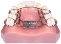 The MemRx EA - Expand / Advance Anteriors When it is necessary to treat a crowded upper or lower arch, the MemRx EA is the appliance of choice.