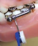 Once both portions or the appliance are cemented into the mouth, re-connect the lower hinge assembly by replacing the Allen screw into the bicuspid pivot.