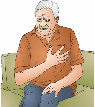 When the narrowing of the arteries is severe, blood flow may become fully blocked. This can cause a heart attack. Rarely, people can have completely clogged arteries without any symptoms.