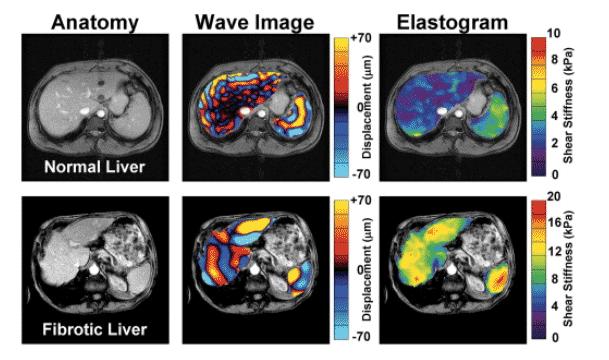 MR Elastography in NAFLD AUROC for diagnosis of advanced fibrosis For Stage 3-4 fibrosis: >3.