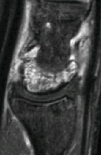 LichtmanI (MRI) osteonecrosis