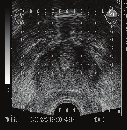 The ultrasound shows the size and shape of the prostate (outlined) as seen on TRUS The computer gives a 3-D image of the prostate, rectum, urethra and seeds.