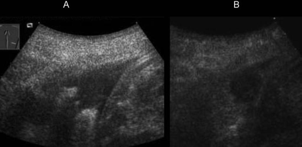 Figure 4. A 70-year-old female patient with pleurisy and a diagnosis of PE (case 13). Top, A: on B-mode sonography a 3 2-cm wedge-shaped hypoechoic lesion was seen.