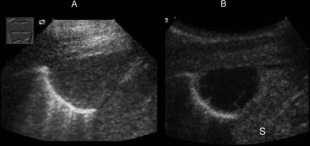 Currently, the use of contrast agents such as this one improve the diagnostic potential of ultrasound examinations in different clinical applications such as in the assessment of carotid and brain