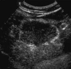 At baseline ultrasound (US),the