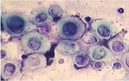 Cryptococcosis Most deaths occur within the first 2 weeks of therapy and related to