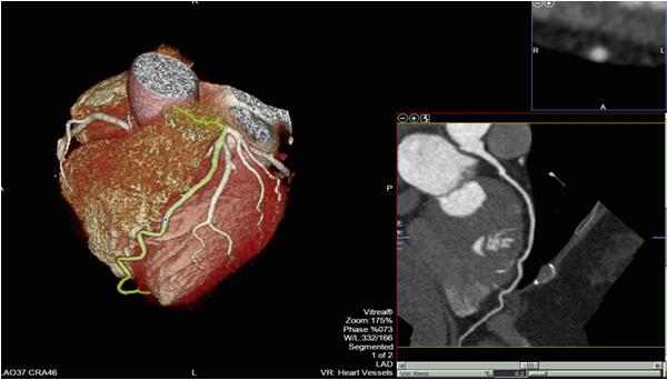Coronary CT angiogram Coronary MR angiogram MRCA vs.